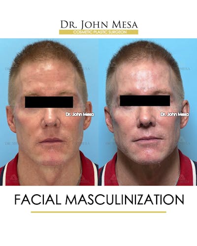 Facial Masculinization Before & After Gallery - Patient 251013 - Image 1