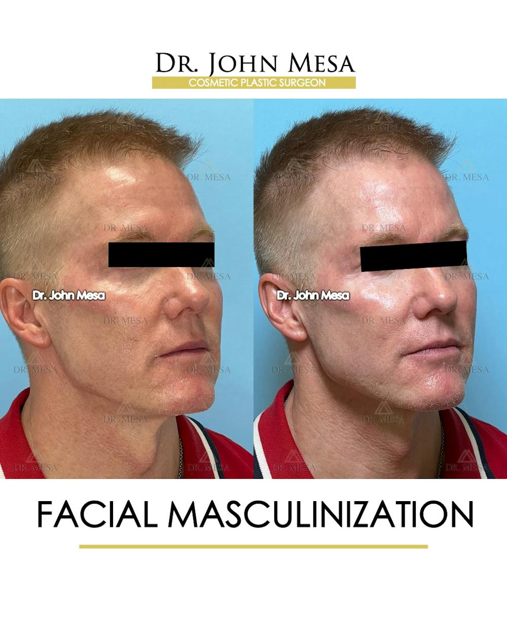 Facial Masculinization Before & After Gallery - Patient 251013 - Image 2
