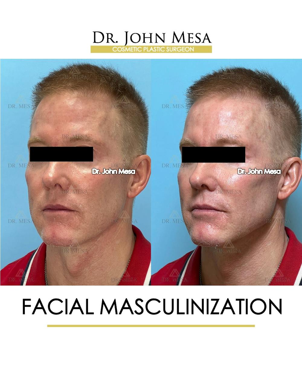 Facial Masculinization Before & After Gallery - Patient 251013 - Image 3