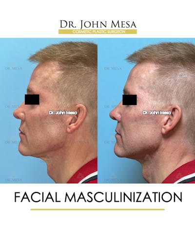 Facial Masculinization Before & After Gallery - Patient 251013 - Image 4