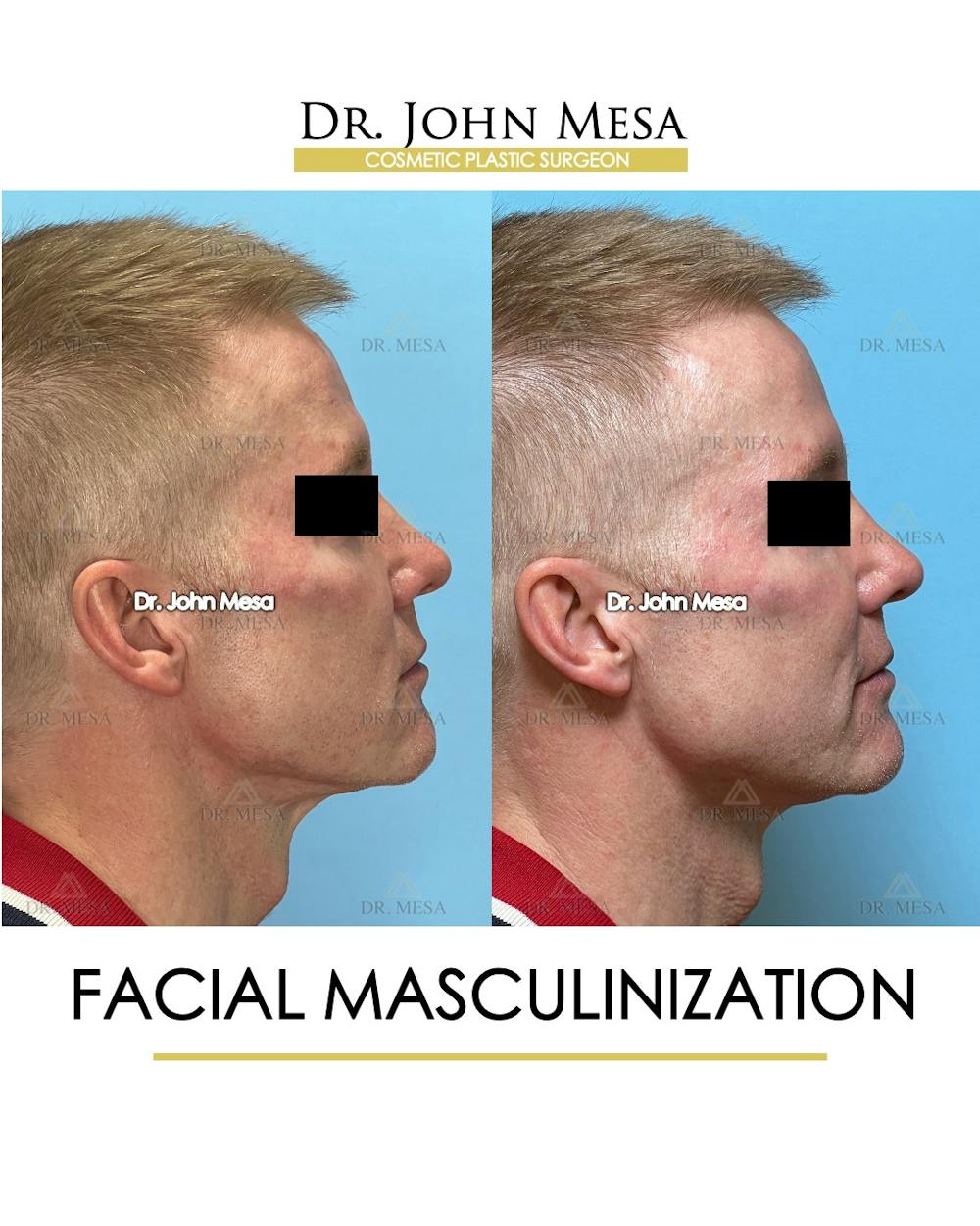 Facial Masculinization Before & After Gallery - Patient 251013 - Image 5