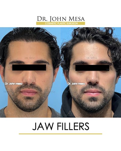 Jaw Filler Before & After Gallery - Patient 231462 - Image 1