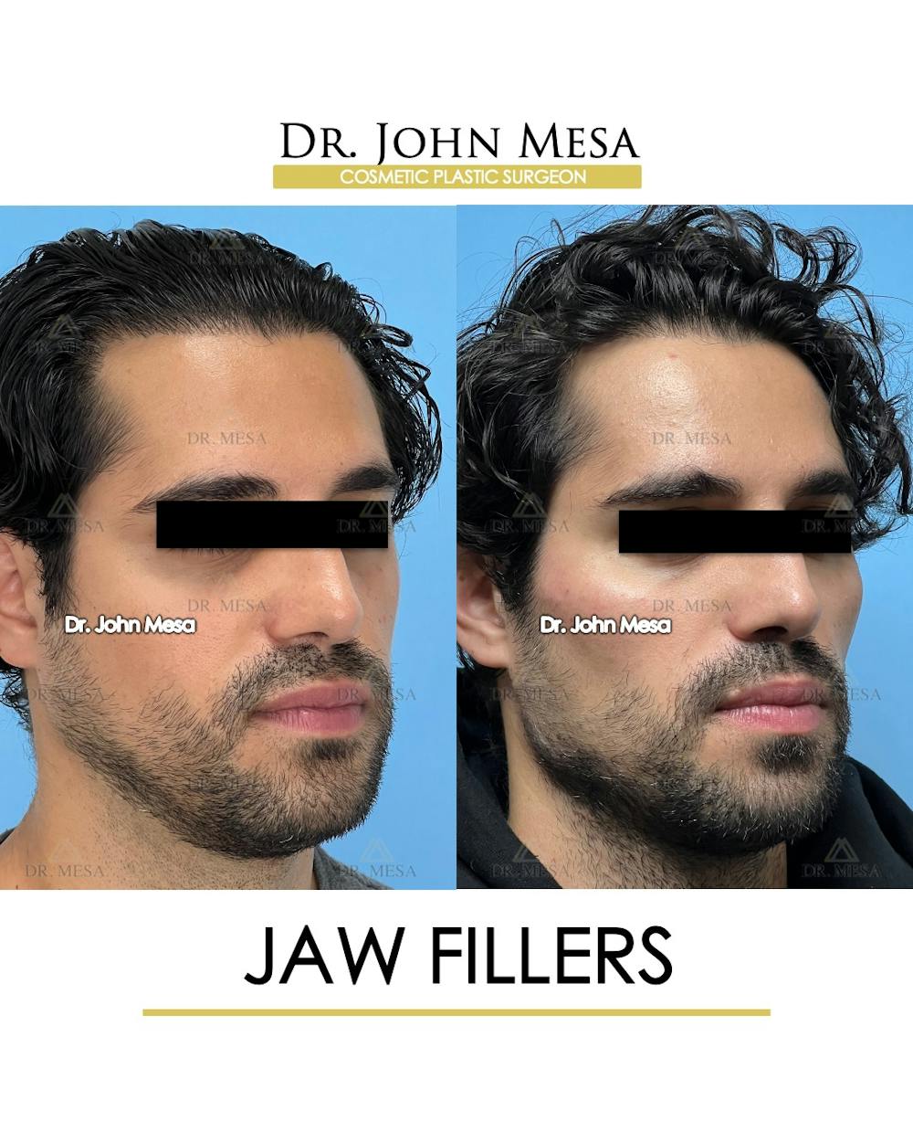 Jaw Filler Before & After Gallery - Patient 231462 - Image 2