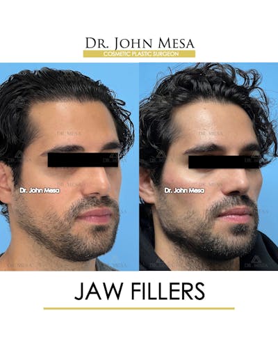 Jaw Filler Before & After Gallery - Patient 231462 - Image 2