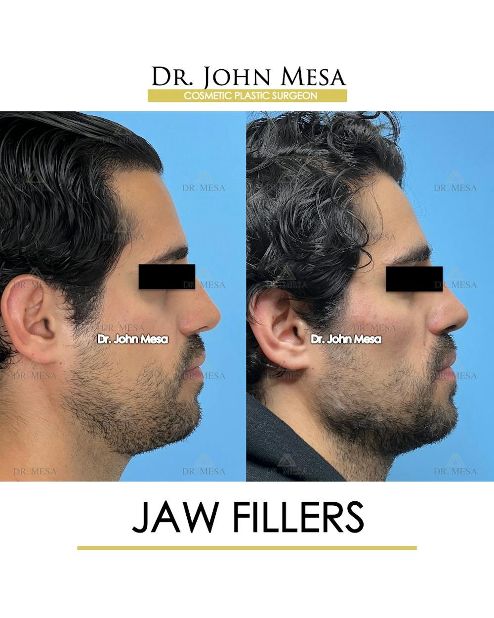 Jaw Filler Before & After Gallery - Patient 231462 - Image 3