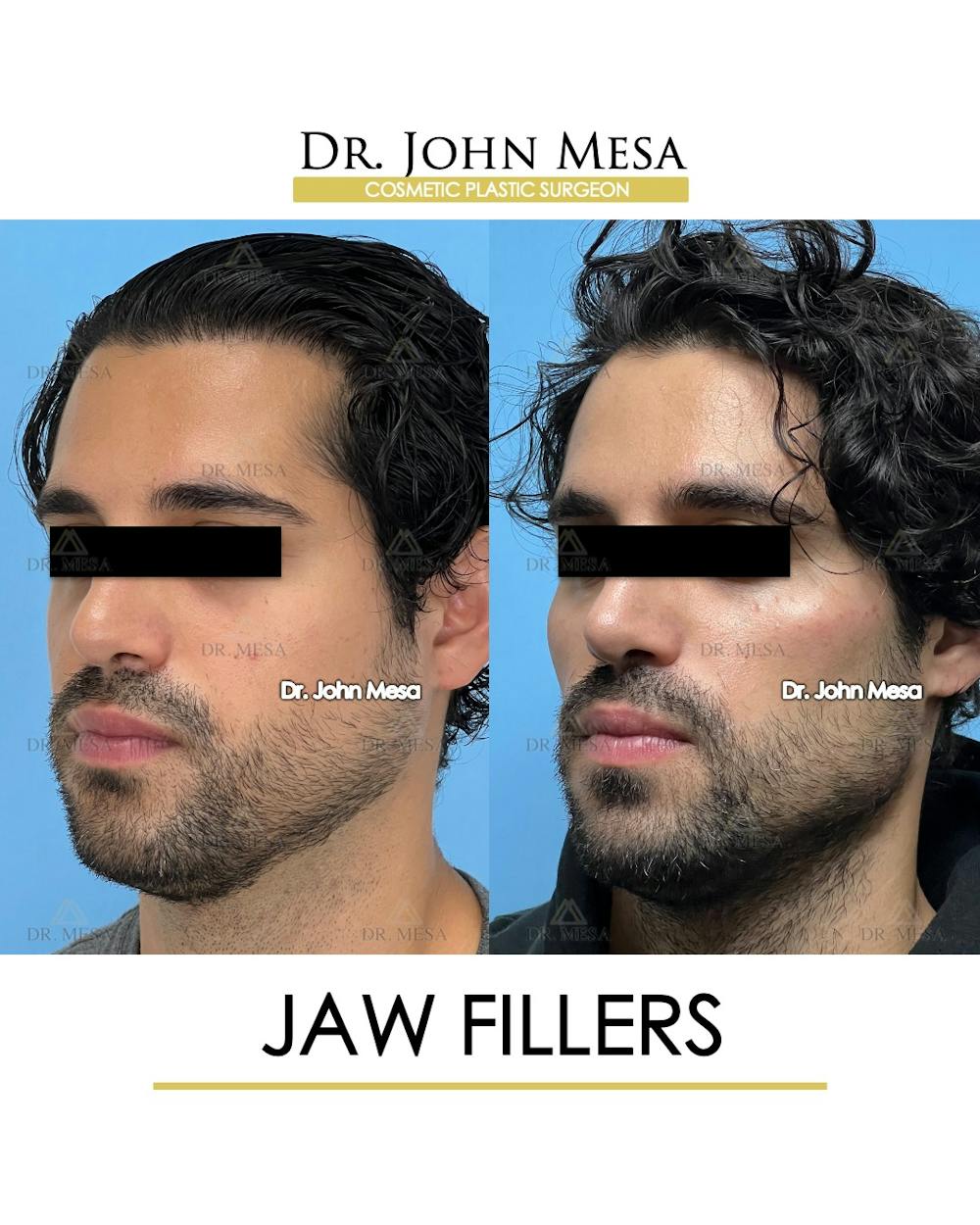 Jaw Filler Before & After Gallery - Patient 231462 - Image 4