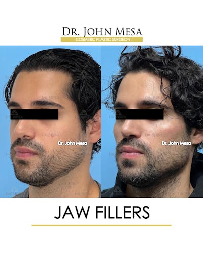 Jaw Filler Before & After Gallery - Patient 231462 - Image 4