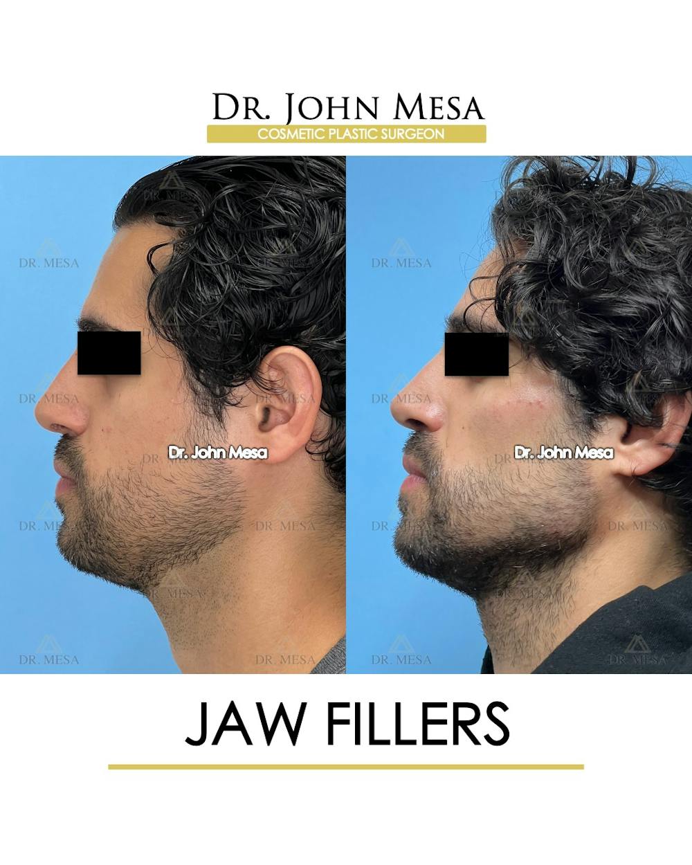 Jaw Filler Before & After Gallery - Patient 231462 - Image 5