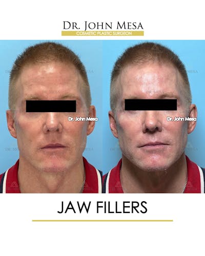Jaw Filler Before & After Gallery - Patient 243157 - Image 1