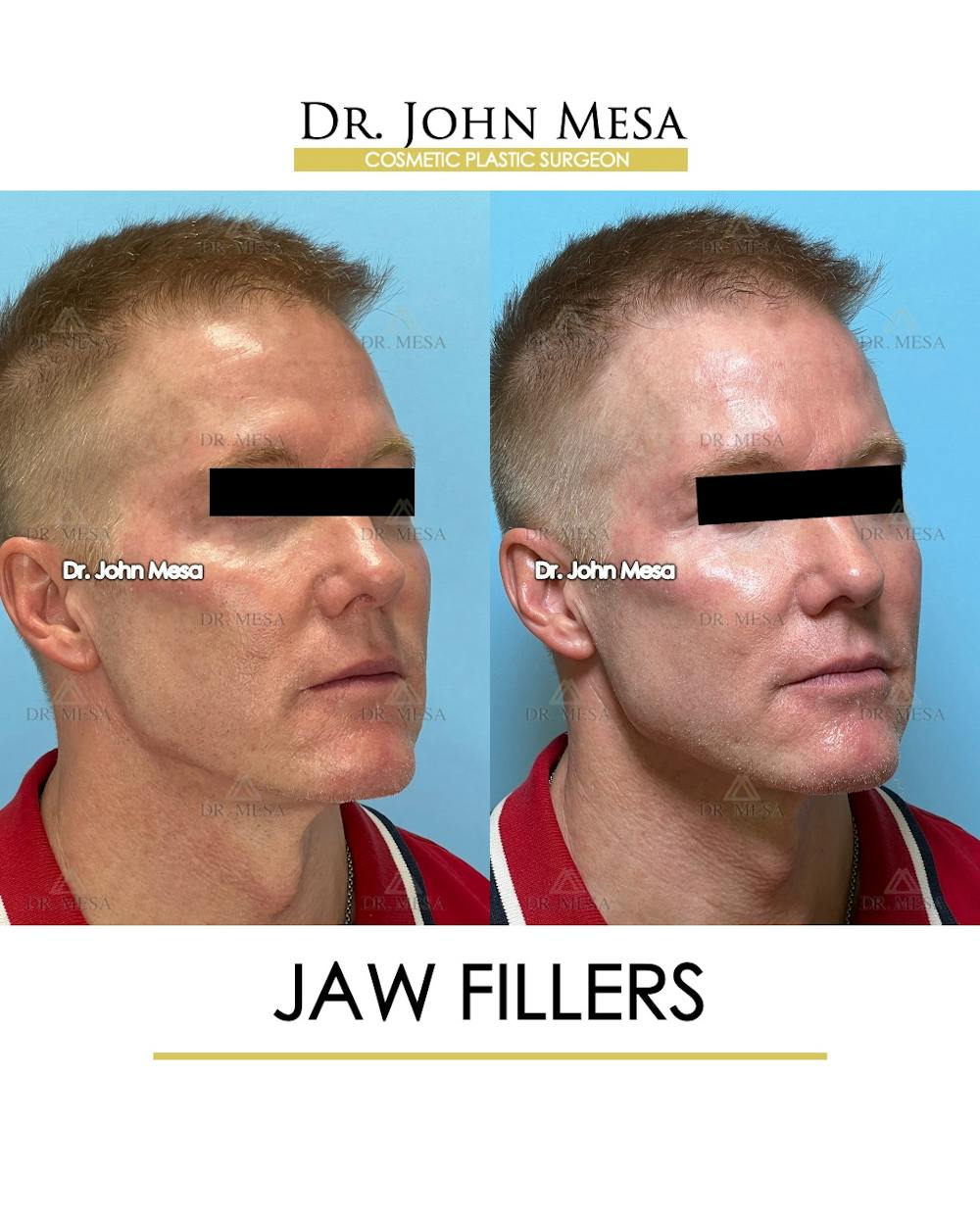 Jaw Filler Before & After Gallery - Patient 243157 - Image 2