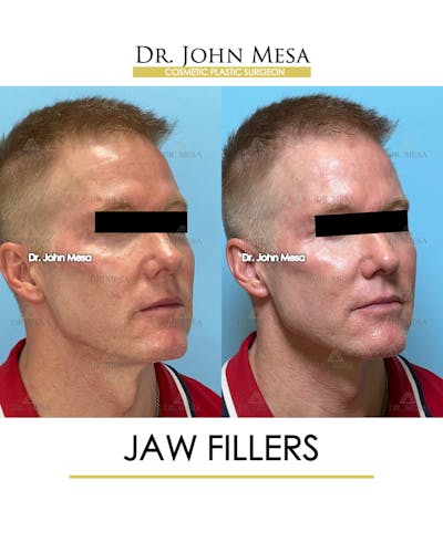 Jaw Filler Before & After Gallery - Patient 243157 - Image 2