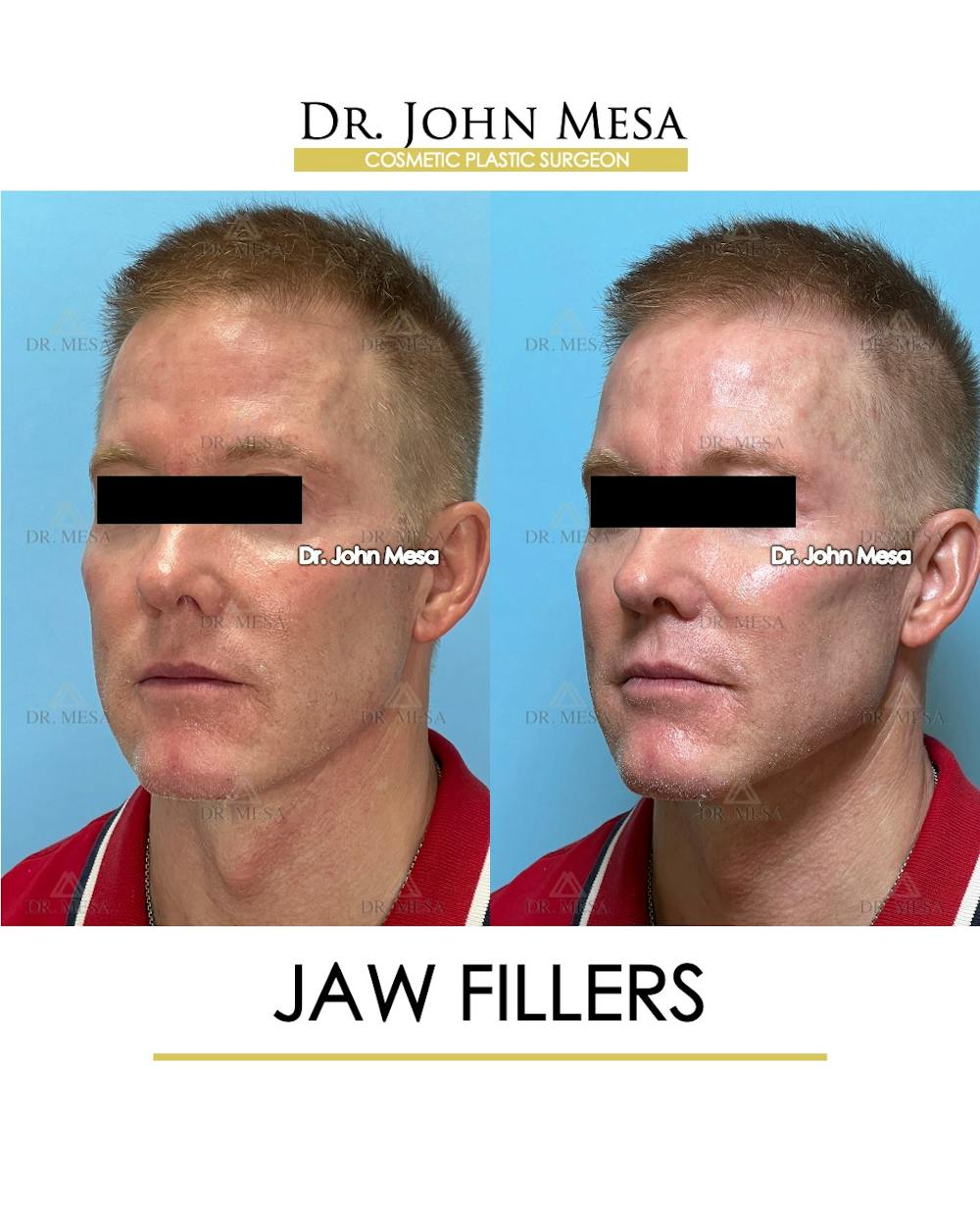 Jaw Filler Before & After Gallery - Patient 243157 - Image 3