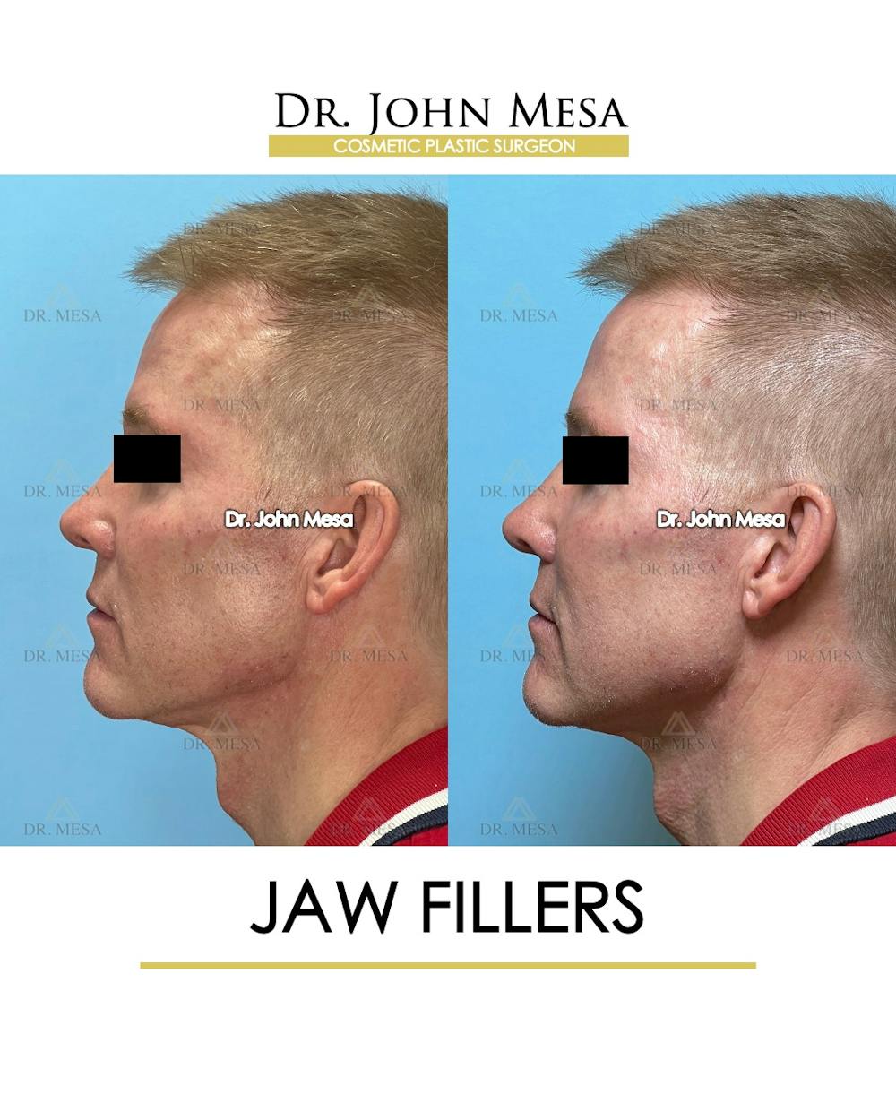 Jaw Filler Before & After Gallery - Patient 243157 - Image 4