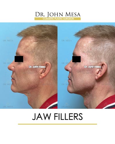 Jaw Filler Before & After Gallery - Patient 243157 - Image 4