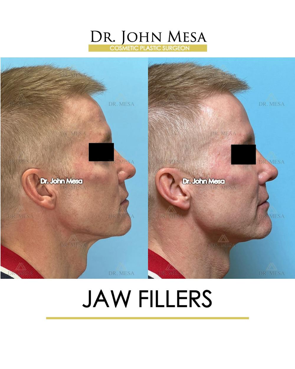 Jaw Filler Before & After Gallery - Patient 243157 - Image 5
