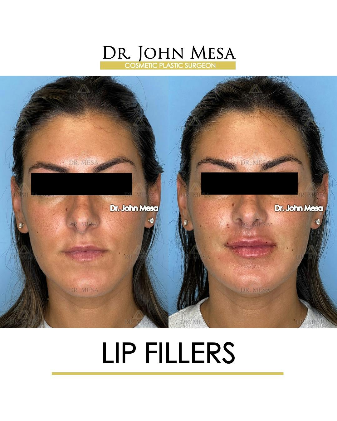 Lip Augmentation (Injectables) Before & After Gallery - Patient 207916 - Image 1