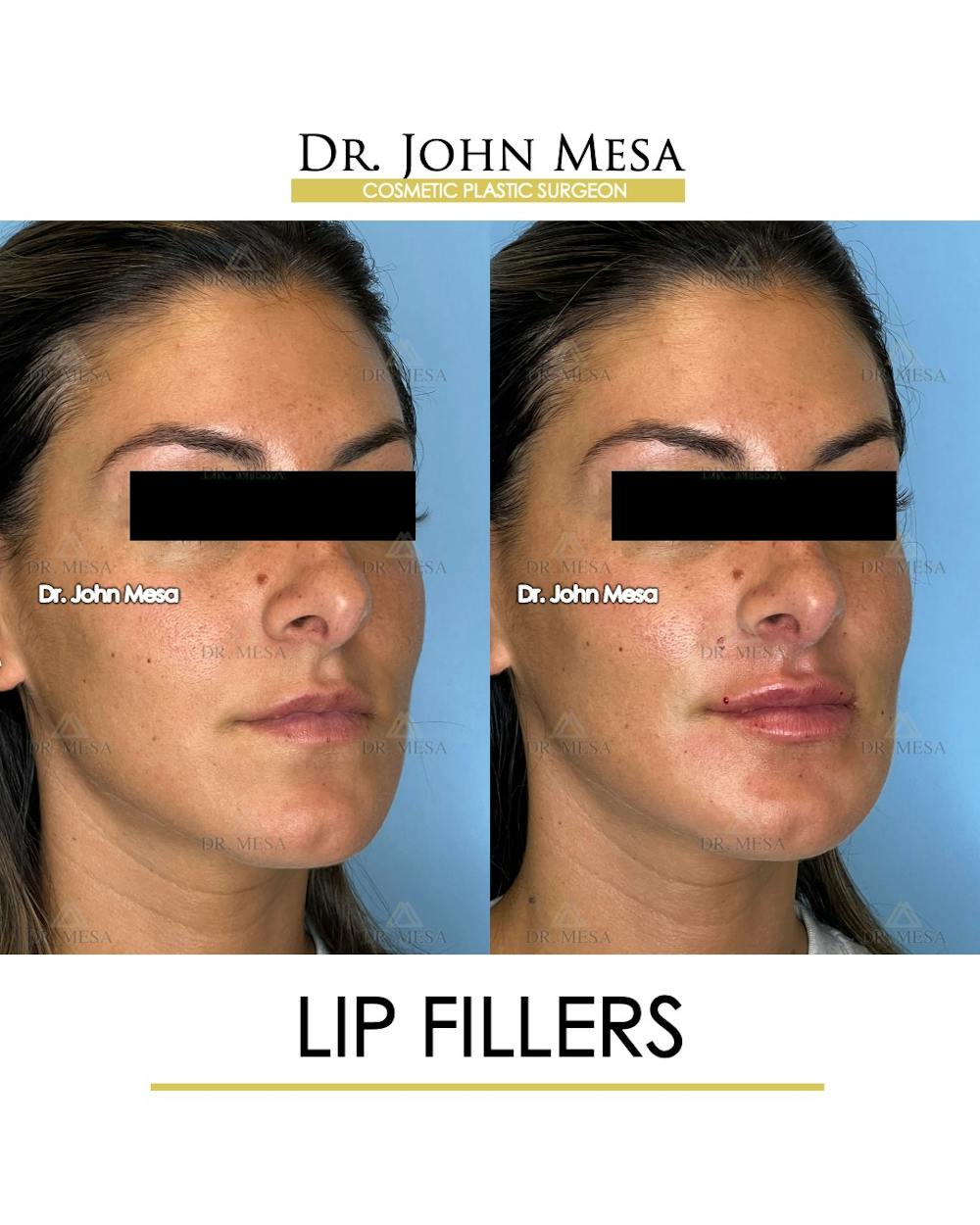 Lip Augmentation (Injectables) Before & After Gallery - Patient 207916 - Image 2