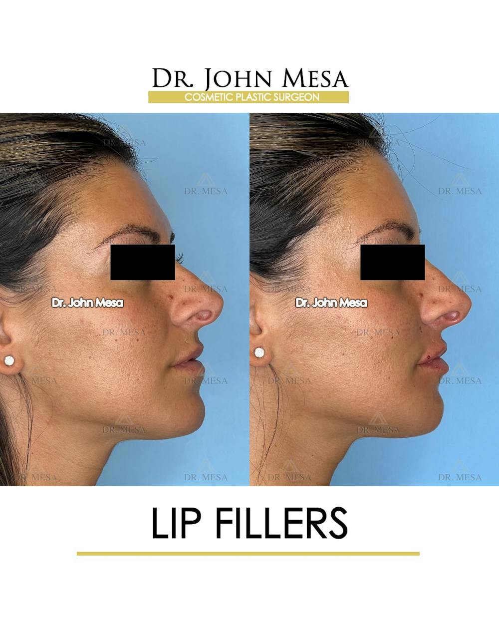 Lip Augmentation (Injectables) Before & After Gallery - Patient 207916 - Image 3