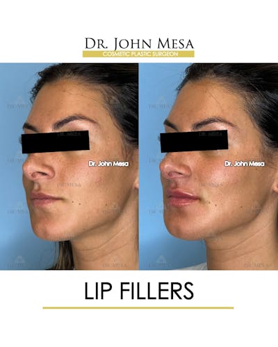 Lip Augmentation (Injectables) Before & After Gallery - Patient 207916 - Image 4
