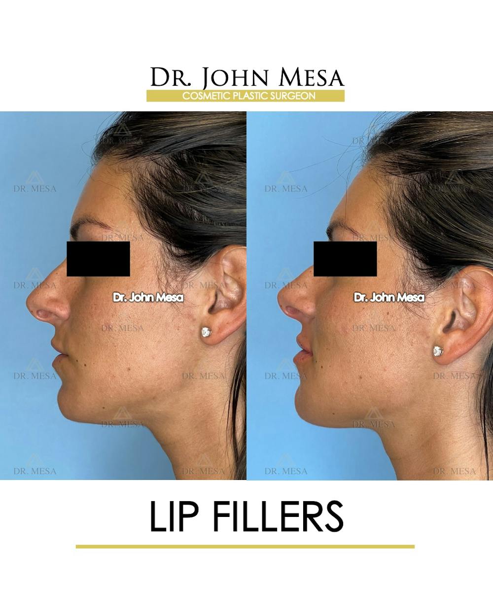 Lip Augmentation (Injectables) Before & After Gallery - Patient 207916 - Image 5