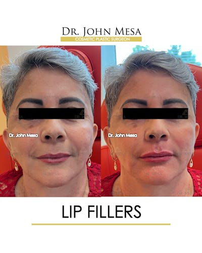 Lip Augmentation (Injectables) Before & After Gallery - Patient 339570 - Image 1