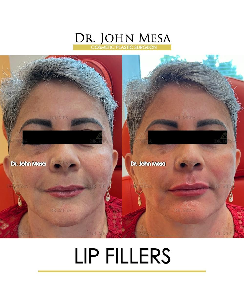 Lip Augmentation (Injectables) Before & After Gallery - Patient 339570 - Image 1