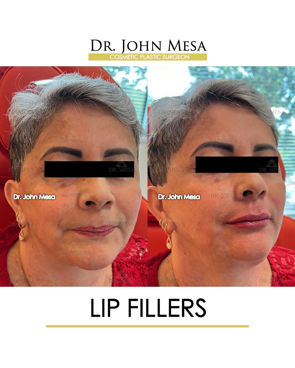 Lip Augmentation (Injectables) Before & After Gallery - Patient 339570 - Image 2