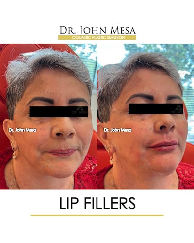 Lip Augmentation (Injectables) Before & After Gallery - Patient 339570 - Image 2