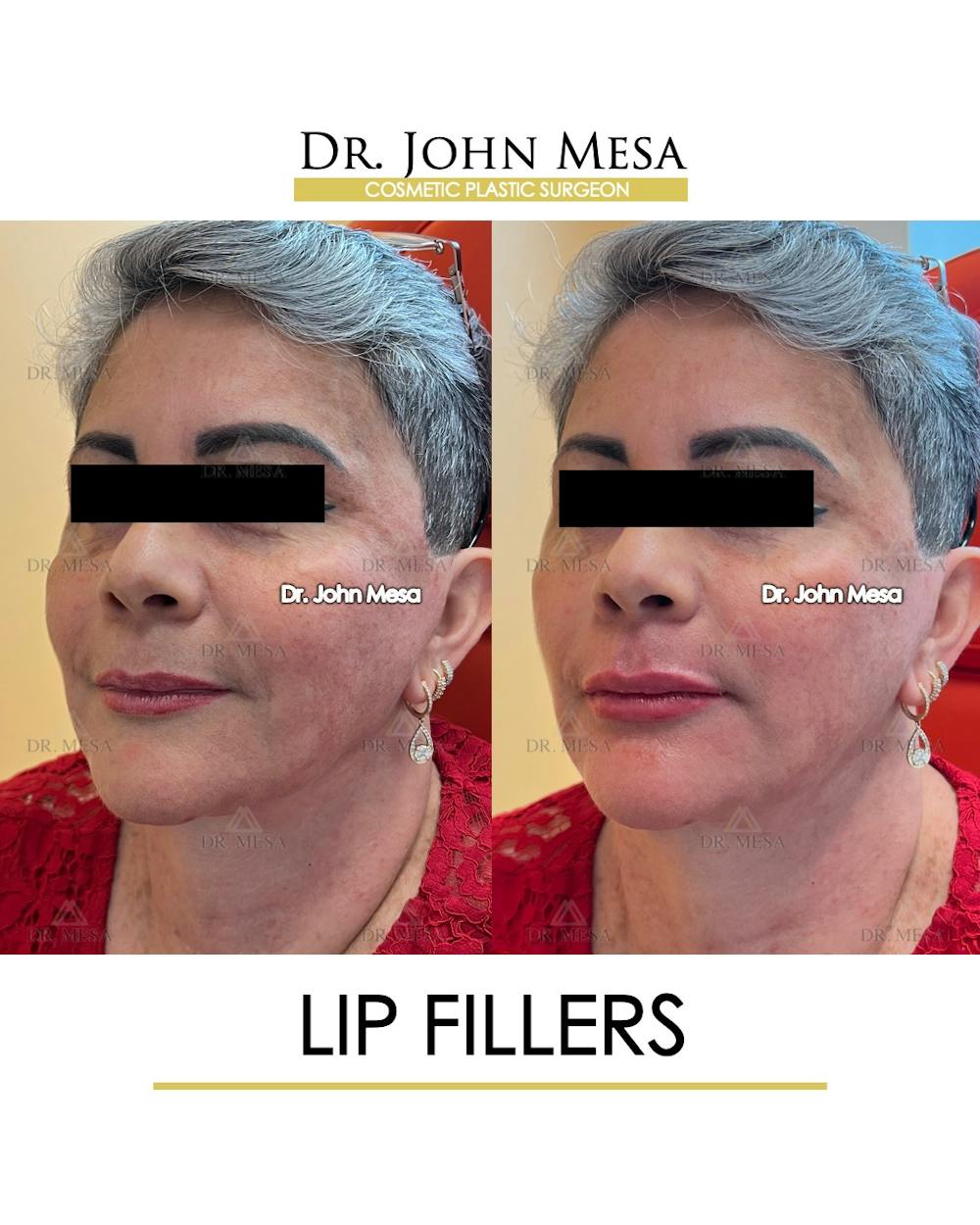 Lip Augmentation (Injectables) Before & After Gallery - Patient 339570 - Image 3