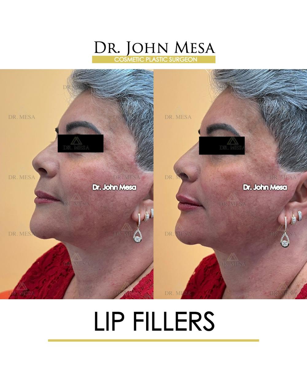Lip Augmentation (Injectables) Before & After Gallery - Patient 339570 - Image 4