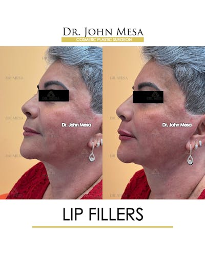 Lip Augmentation (Injectables) Before & After Gallery - Patient 339570 - Image 4