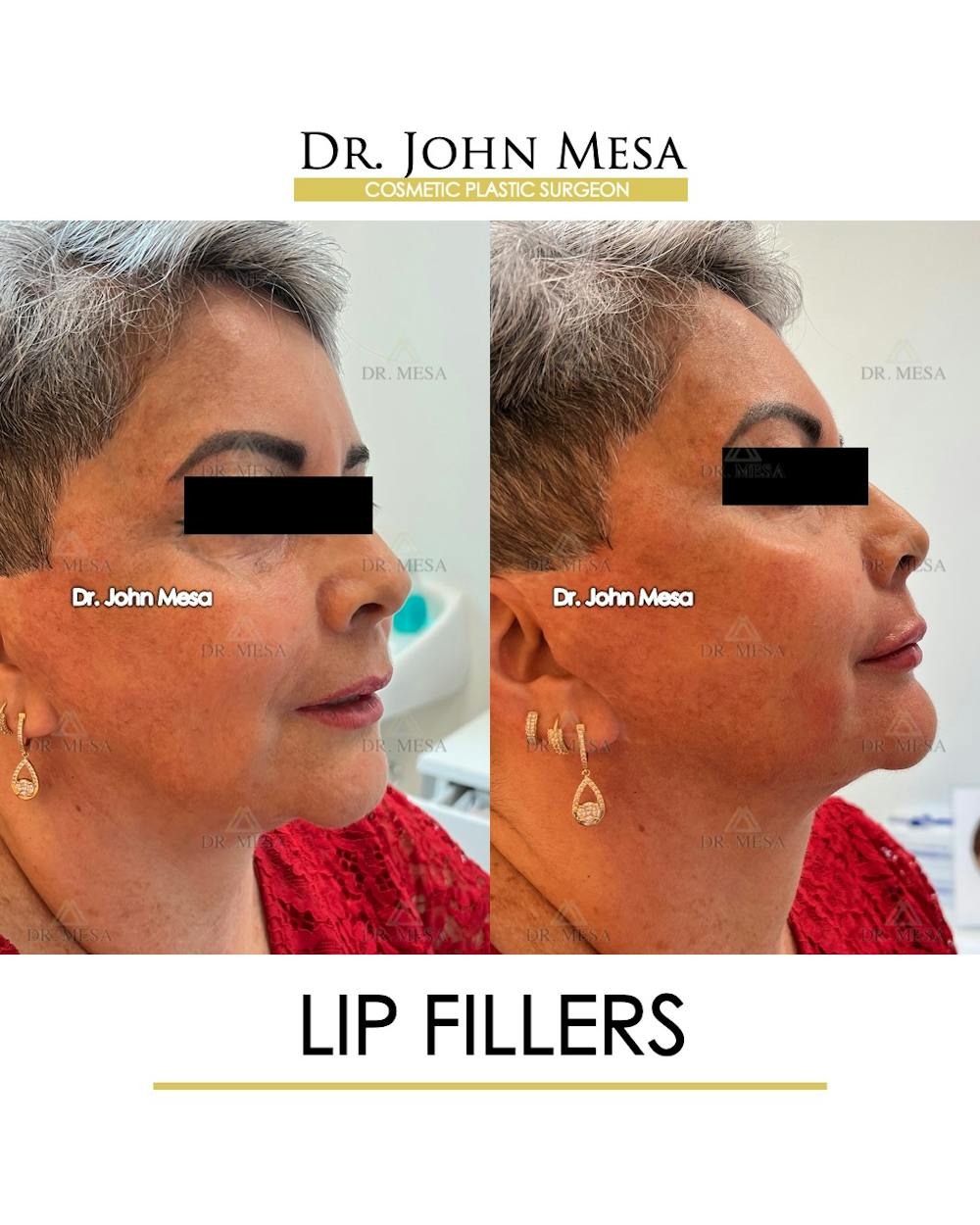 Lip Augmentation (Injectables) Before & After Gallery - Patient 339570 - Image 5