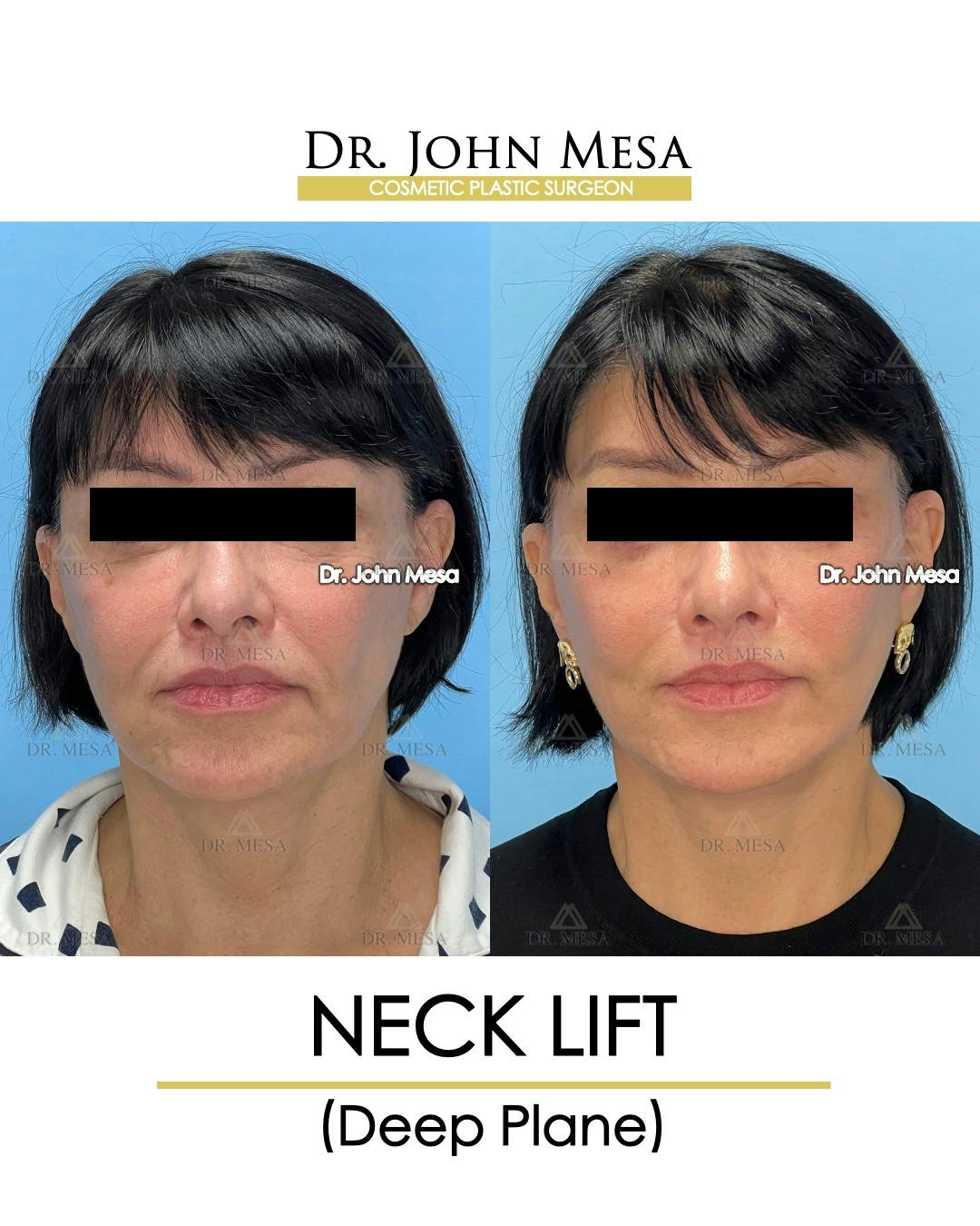 Neck Lift Before & After Gallery - Patient 384454 - Image 1