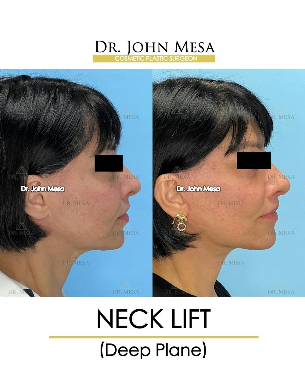 Neck Lift Before & After Gallery - Patient 384454 - Image 3