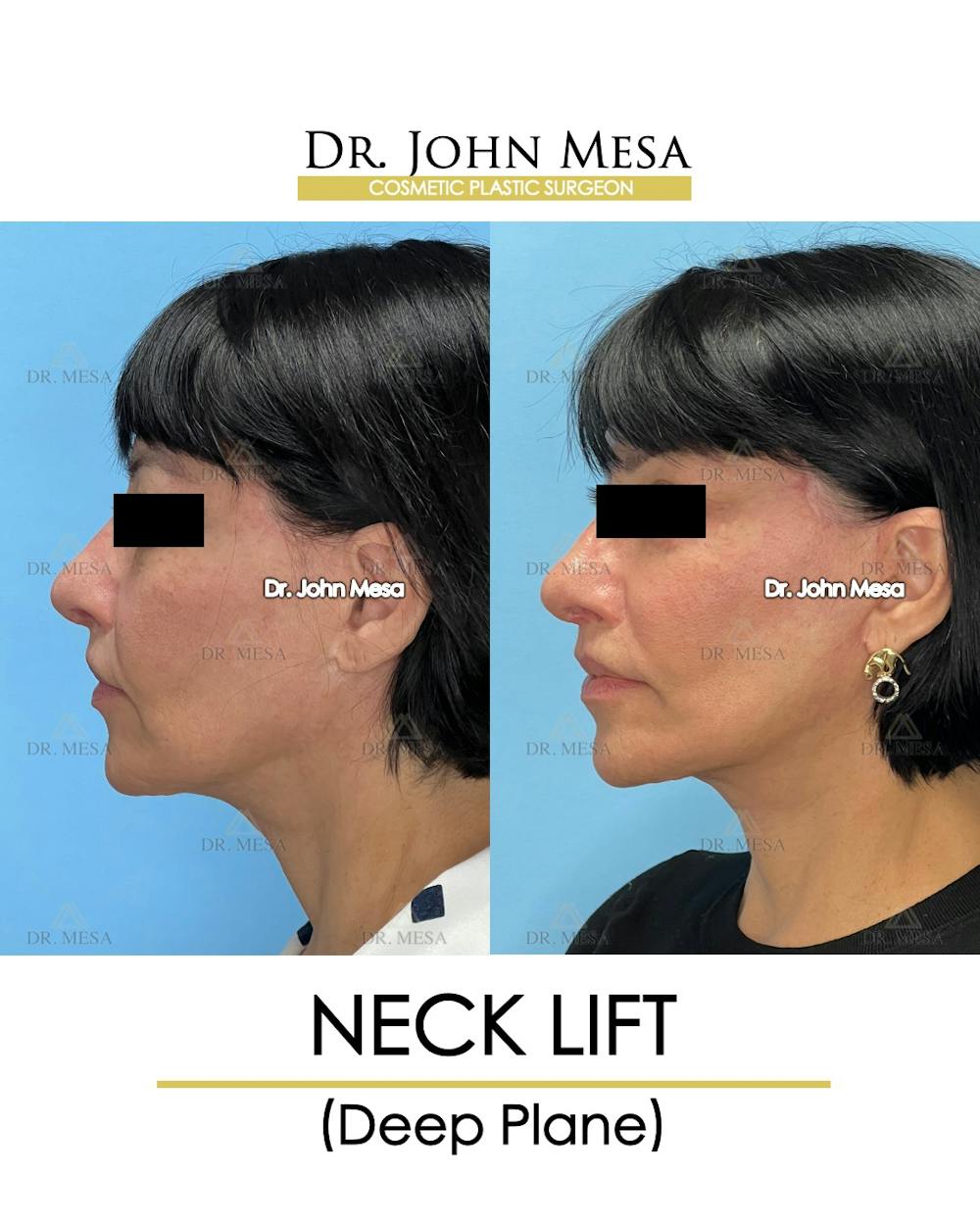 Neck Lift Before & After Gallery - Patient 384454 - Image 5