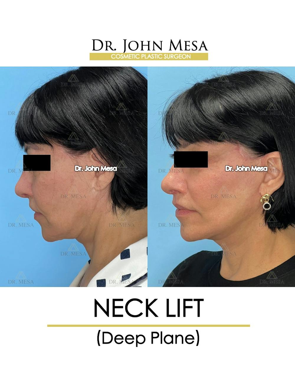 Neck Lift Before & After Gallery - Patient 384454 - Image 6