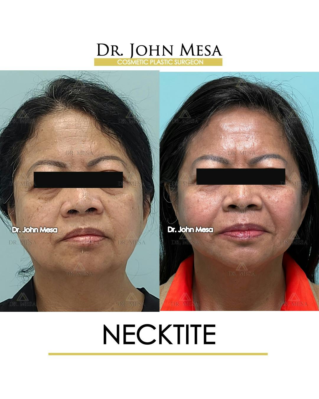 NeckTite Before & After Gallery - Patient 306129 - Image 1