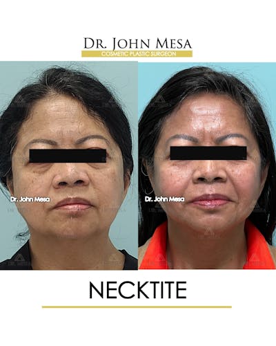 NeckTite Before & After Gallery - Patient 306129 - Image 1