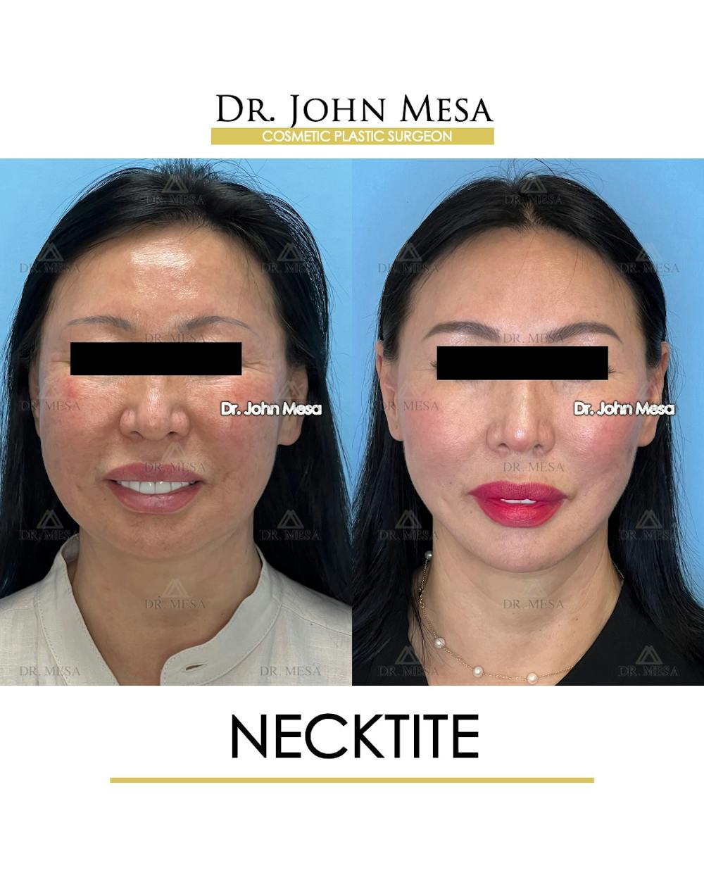 NeckTite Before & After Gallery - Patient 579255 - Image 2