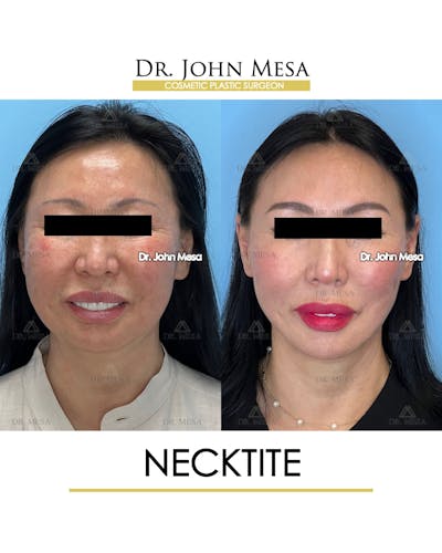 NeckTite Before & After Gallery - Patient 579255 - Image 2