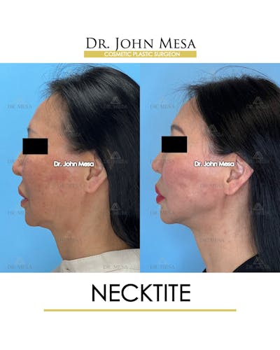 NeckTite Before & After Gallery - Patient 579255 - Image 6