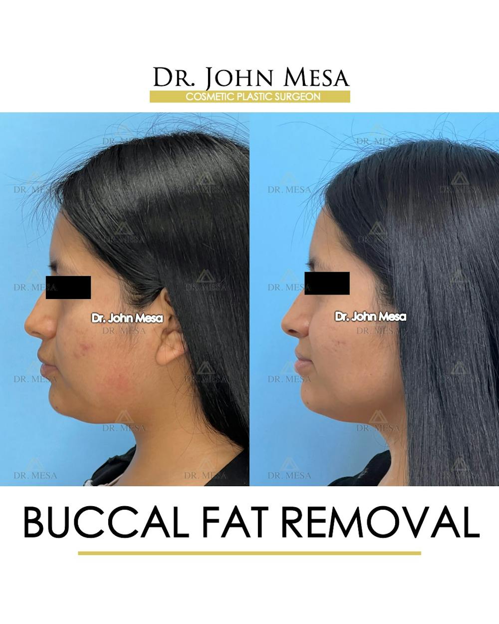 Buccal Fat Pad Removal Before & After Gallery - Patient 356525 - Image 6