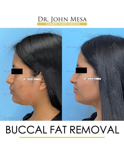 Buccal Fat Pad Removal Before & After Gallery - Patient 356525 - Image 6