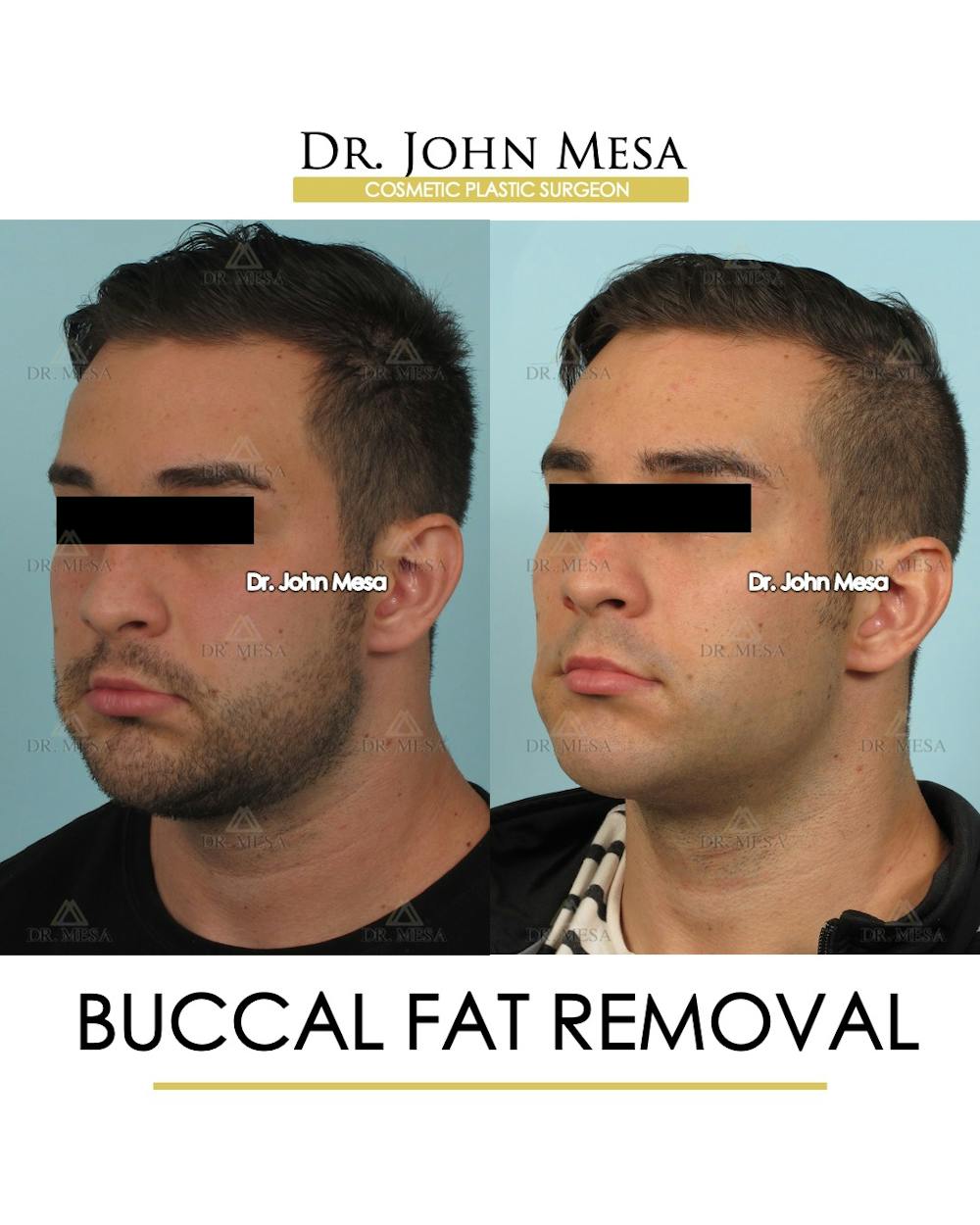 Buccal Fat Pad Removal for Men Before & After Gallery - Patient 380225 - Image 3