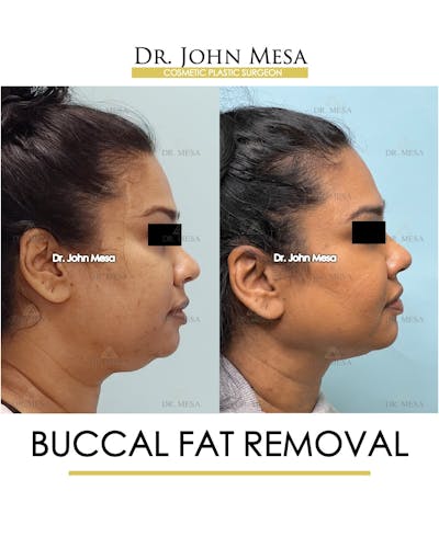 Buccal Fat Pad Removal Before & After Gallery - Patient 142715 - Image 4