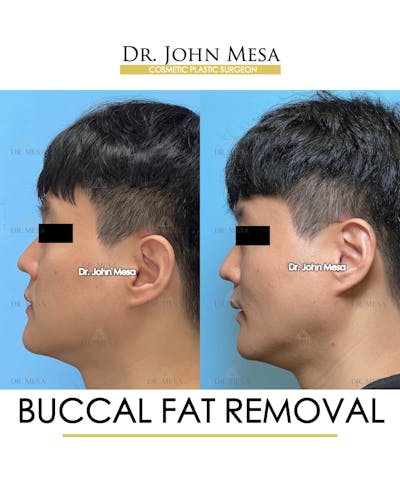 Buccal Fat Pad Removal for Men Before & After Gallery - Patient 401938 - Image 6