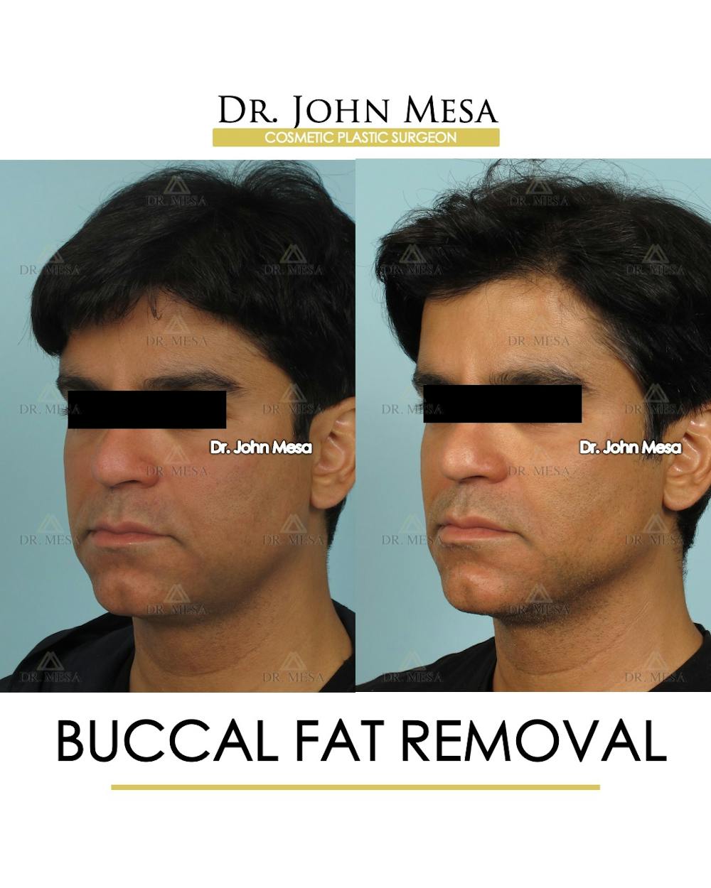 Buccal Fat Pad Removal for Men Before & After Gallery - Patient 335070 - Image 2
