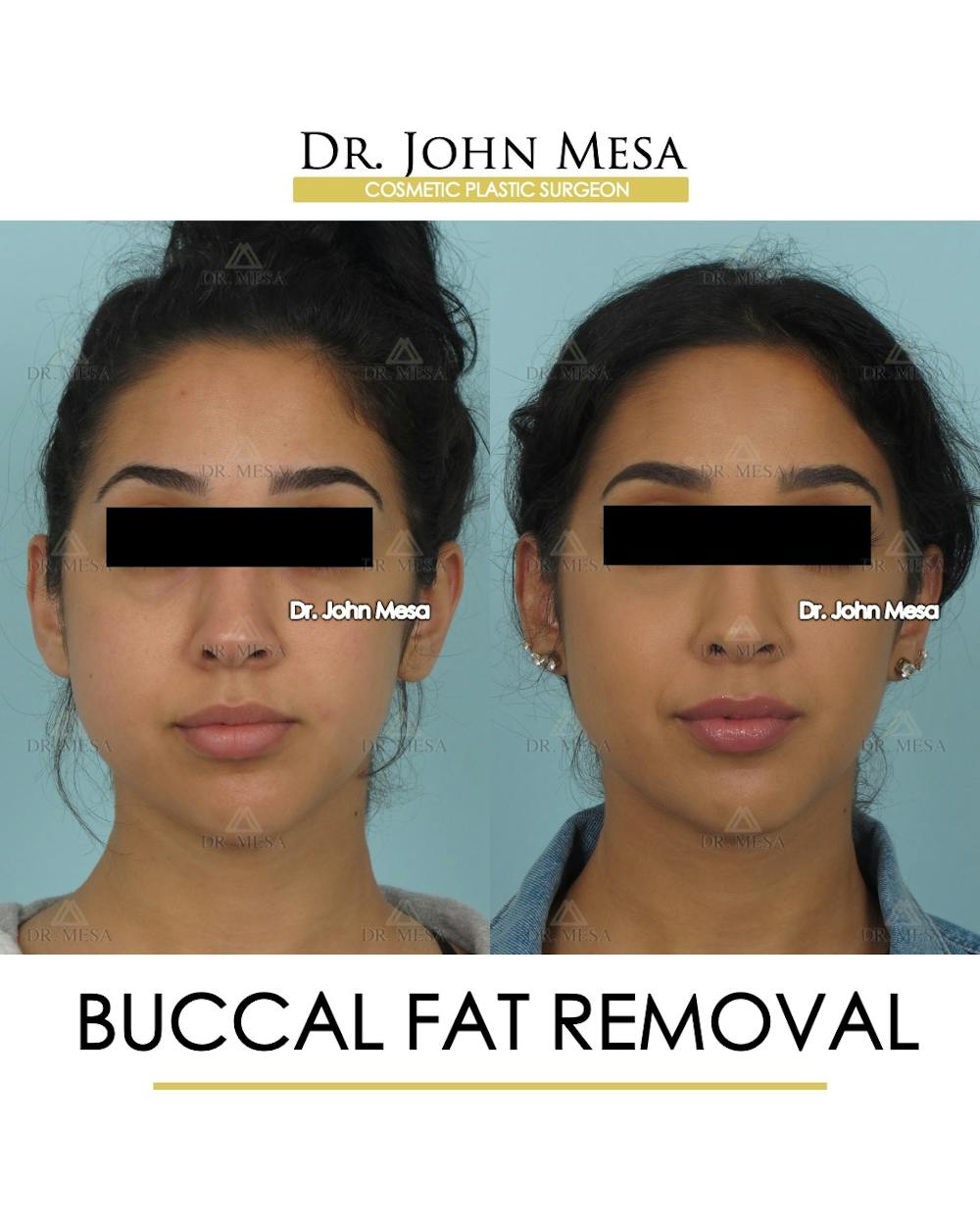 Buccal Fat Pad Removal Before & After Gallery - Patient 528817 - Image 1