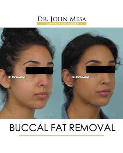 Buccal Fat Pad Removal Before & After Gallery - Patient 528817 - Image 2