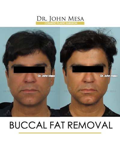 Buccal Fat Pad Removal for Men Before & After Gallery - Patient 335070 - Image 1